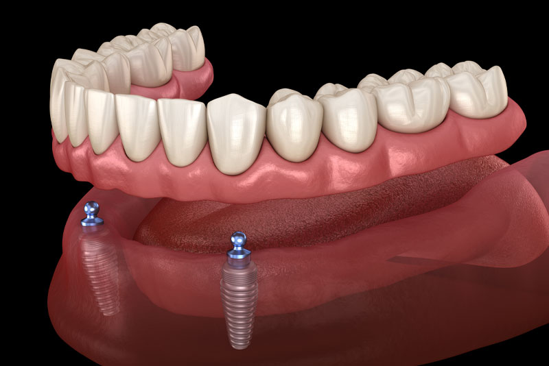 implant supported dentures