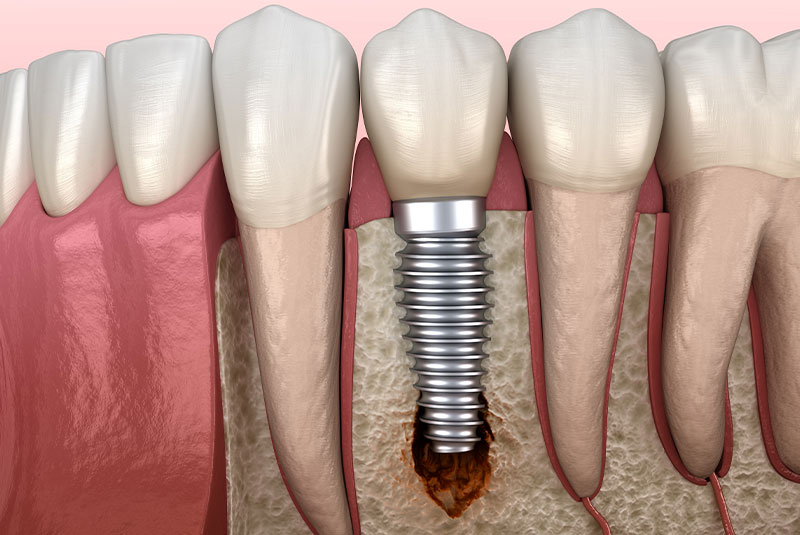 Peri-implantitis