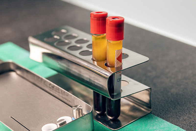 L-PRF (Leukocyte-Platelet Rich Fibrin)