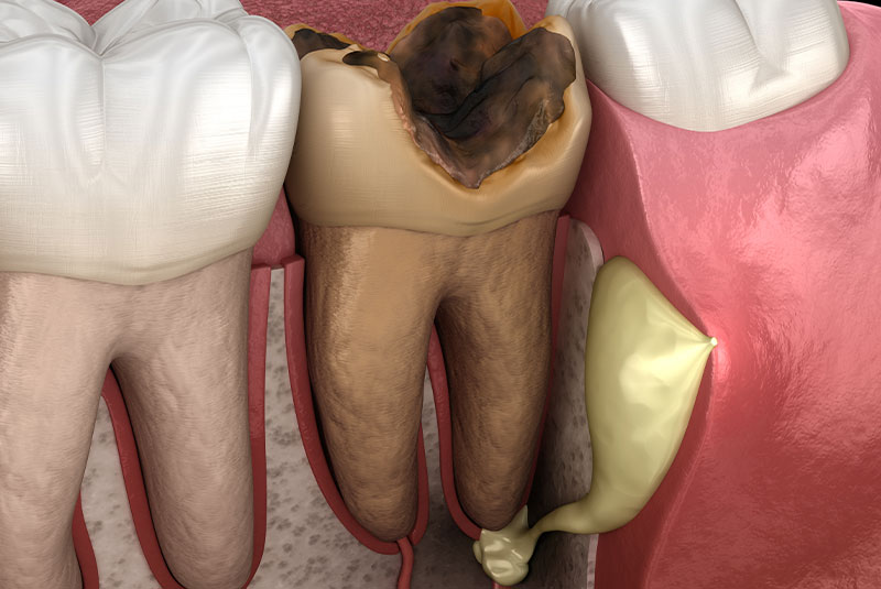 Tooth Abscess