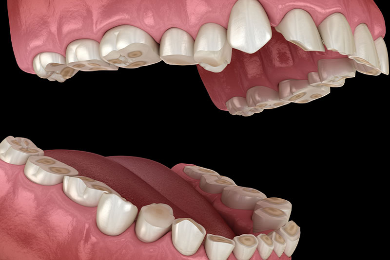 Bruxism