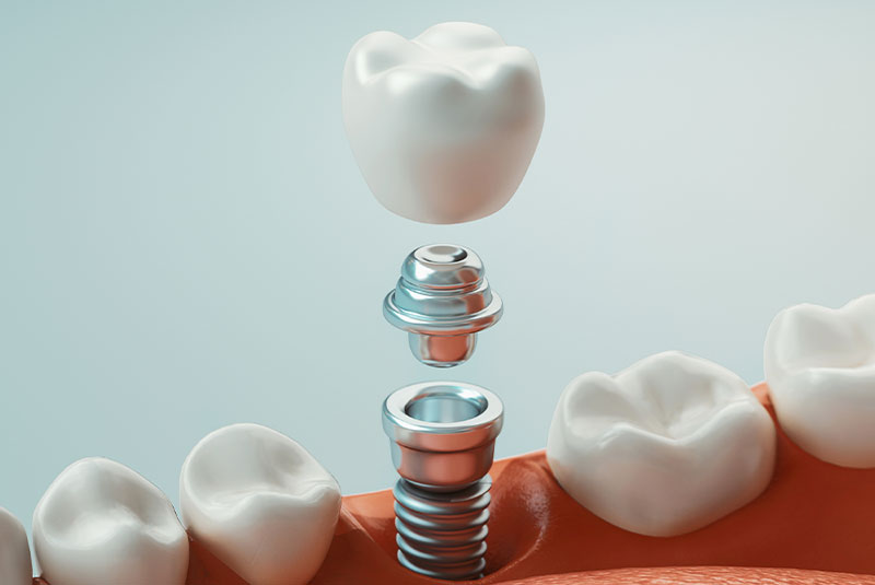 Dental Implants