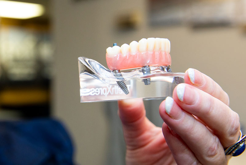 Model of full arch implants